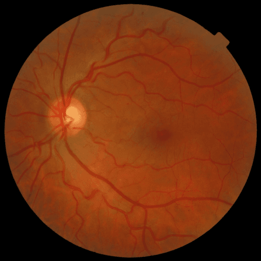 No Diabetic Retinopathy — MESSIDOR-2