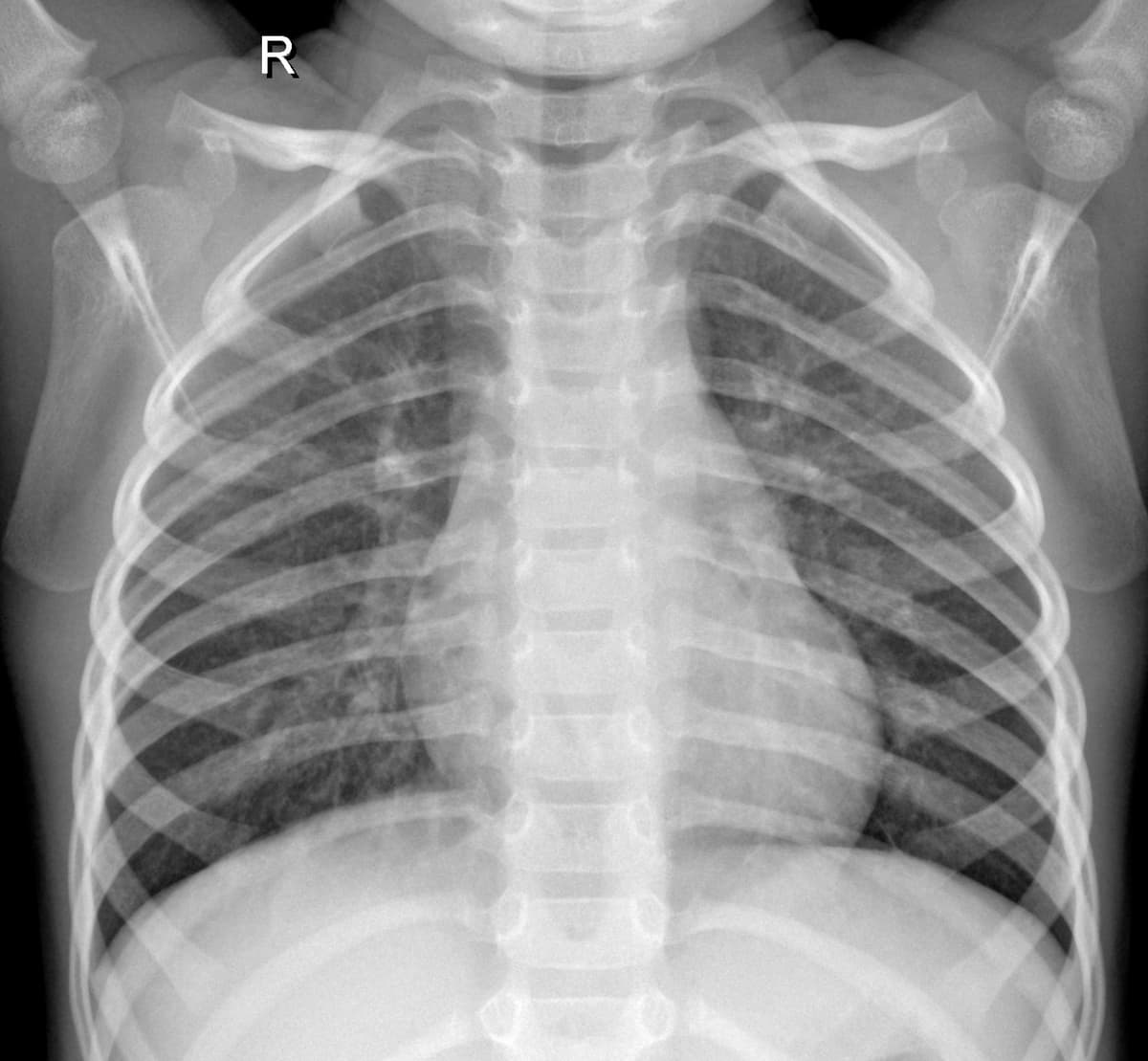 Radiografia Normal — NIH Chest X-ray14
