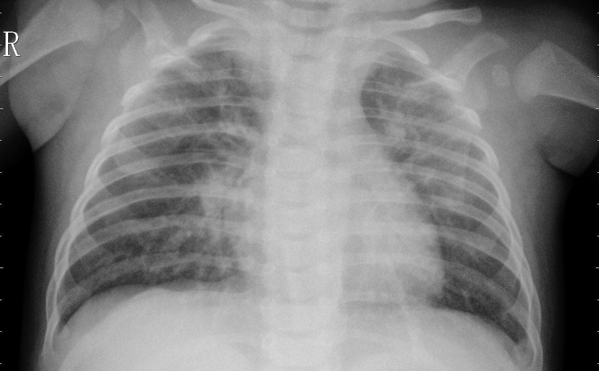 Pneumonia — NIH Chest X-ray14