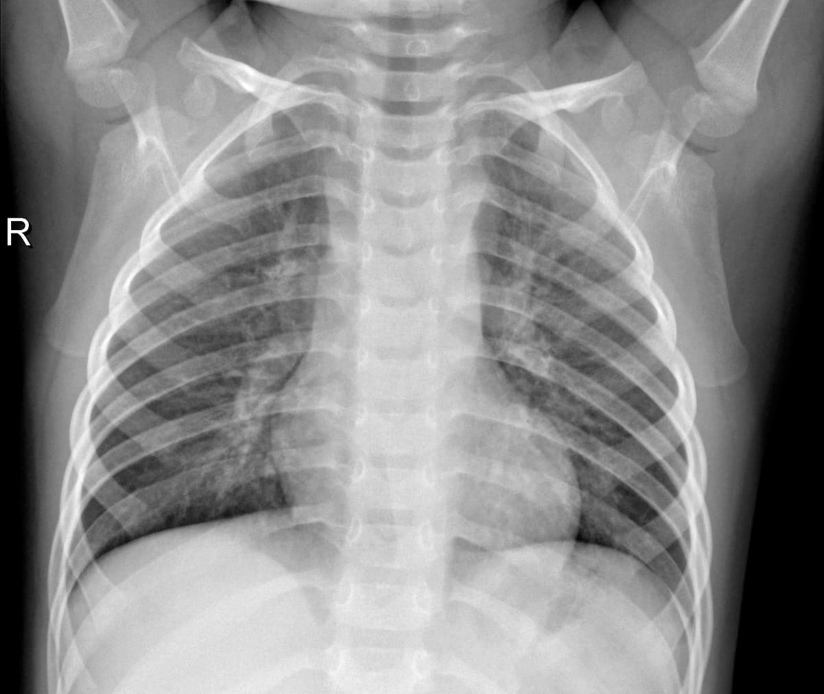 Radiografia Normal — NIH Chest X-ray14