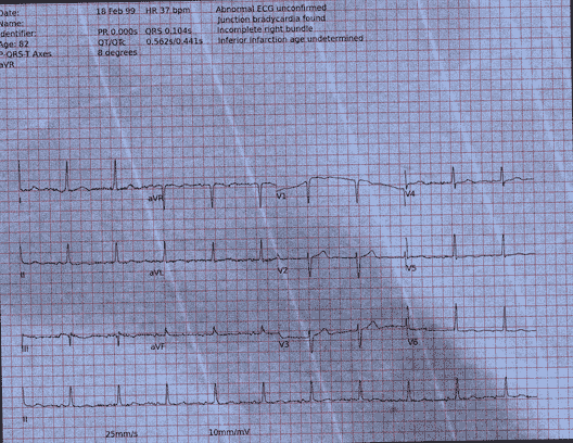 Normal ECG — PTB-XL