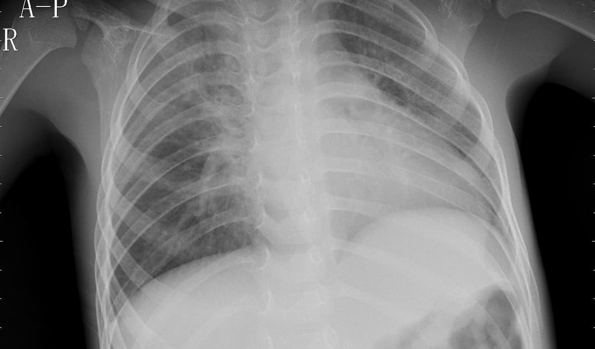 Pneumonia — NIH Chest X-ray14