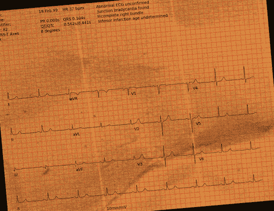 Normal ECG — PTB-XL
