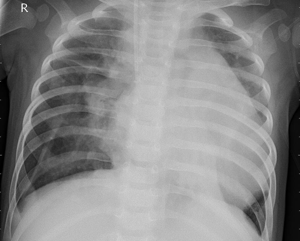 Pneumonia — NIH Chest X-ray14