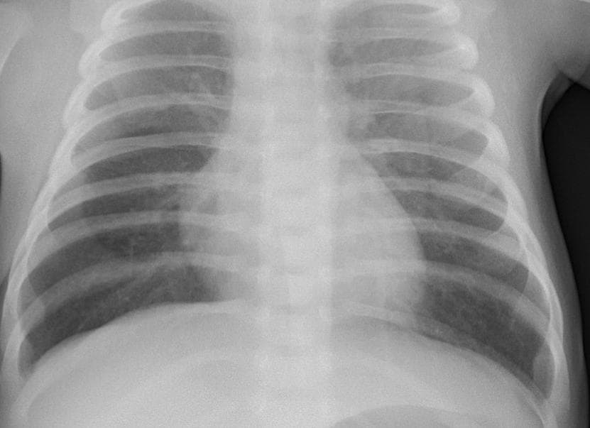 Pneumonia — NIH Chest X-ray14