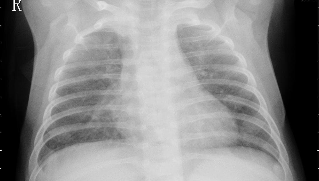 Pneumonia — NIH Chest X-ray14