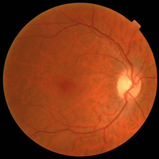 No Diabetic Retinopathy — MESSIDOR-2