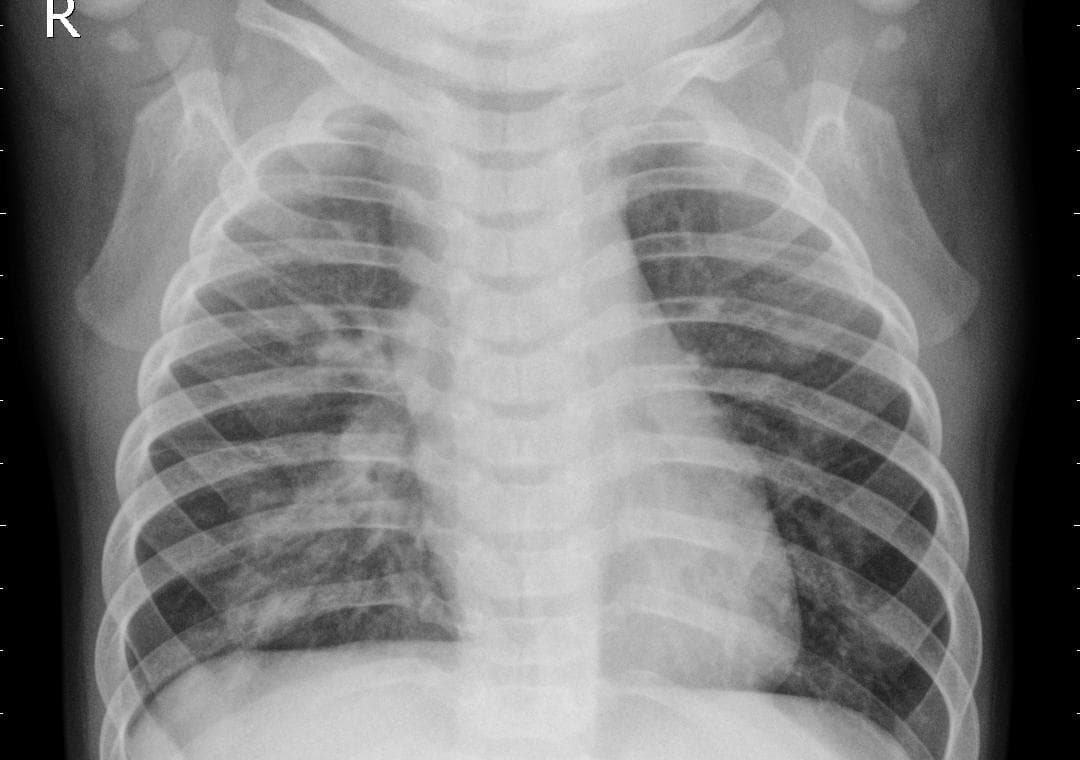 Pneumonia — NIH Chest X-ray14