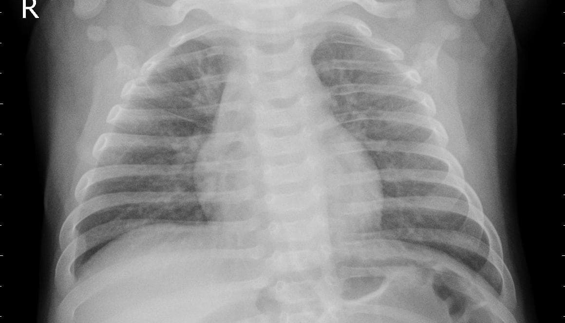 Pneumonia — NIH Chest X-ray14