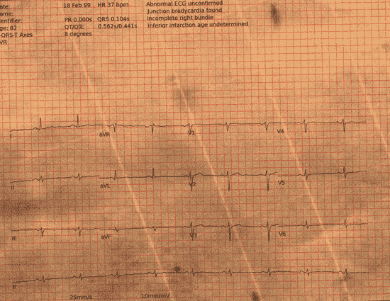 Normal ECG — PTB-XL