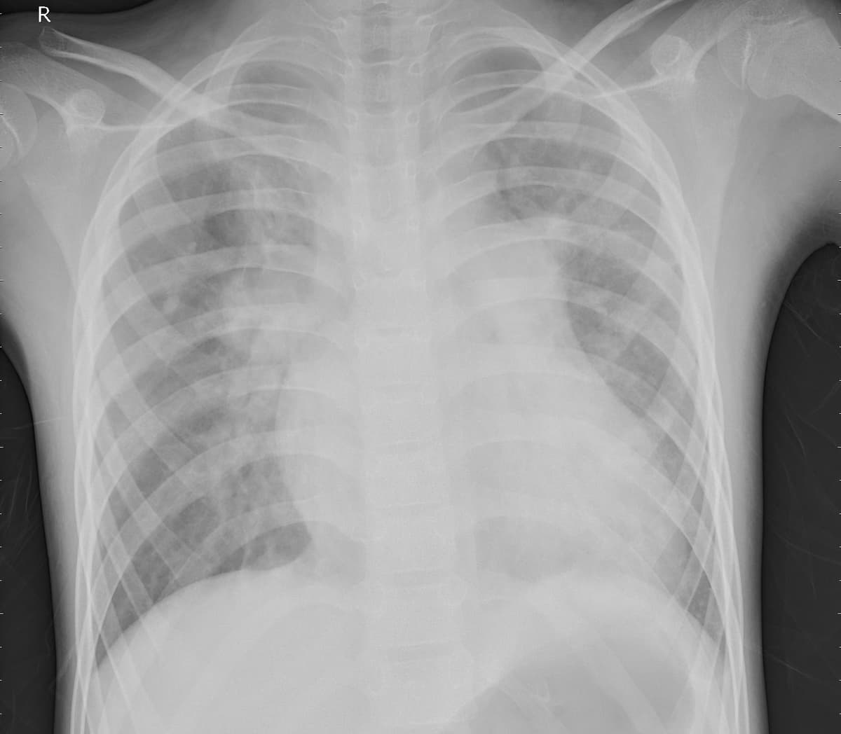 Pneumonia — NIH Chest X-ray14