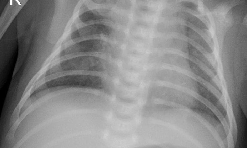 Pneumonia — NIH Chest X-ray14