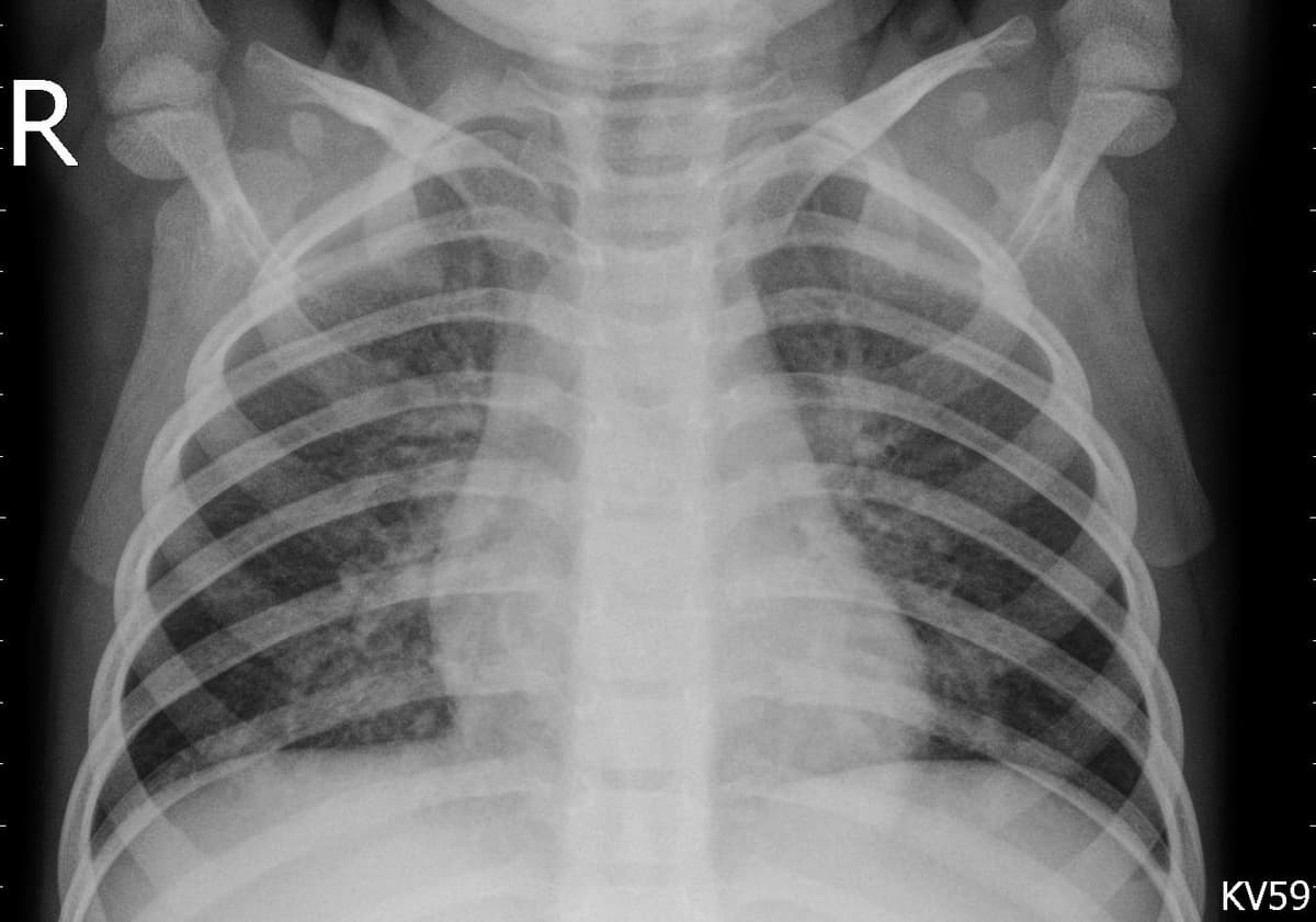 Pneumonia — NIH Chest X-ray14
