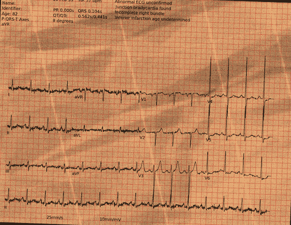 Normal ECG — PTB-XL