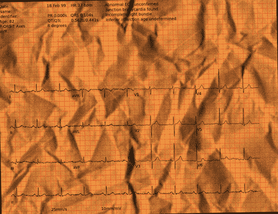 Normal ECG — PTB-XL