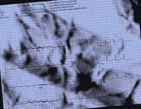 Normal ECG — PTB-XL