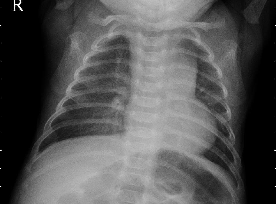 Pneumonia — NIH Chest X-ray14