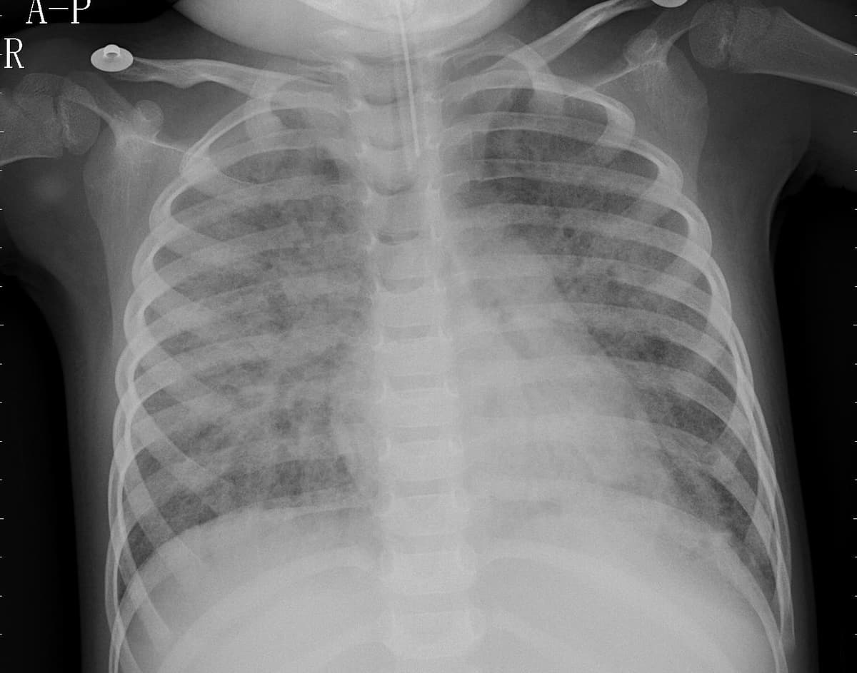Pneumonia — NIH Chest X-ray14
