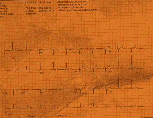 Normal ECG — PTB-XL