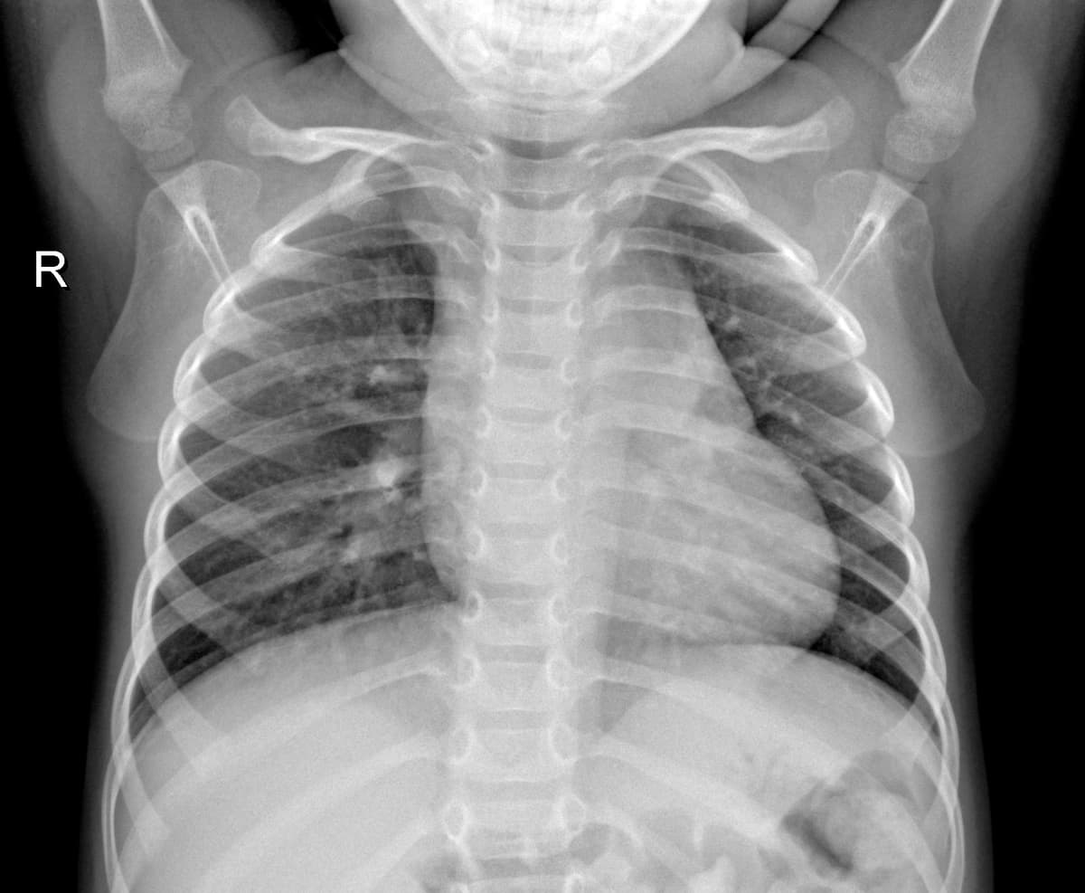 Radiografia Normal — NIH Chest X-ray14