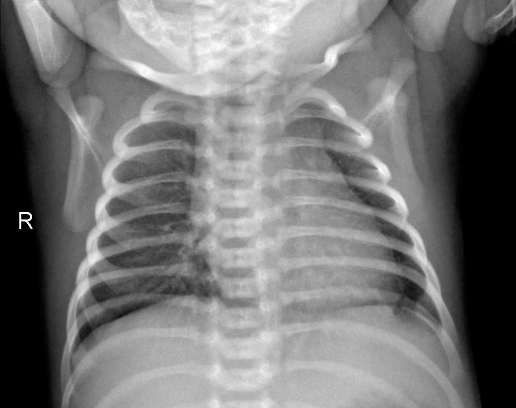 Radiografia Normal — NIH Chest X-ray14
