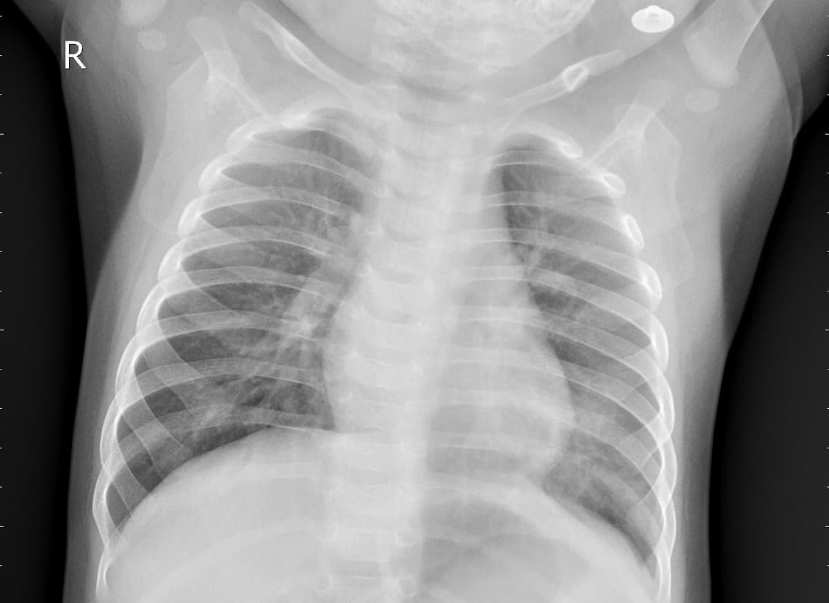 Pneumonia — NIH Chest X-ray14