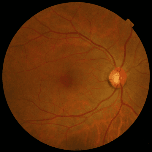 No Diabetic Retinopathy — MESSIDOR-2