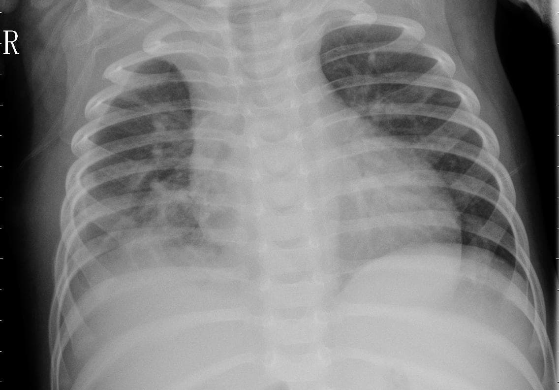 Pneumonia — NIH Chest X-ray14