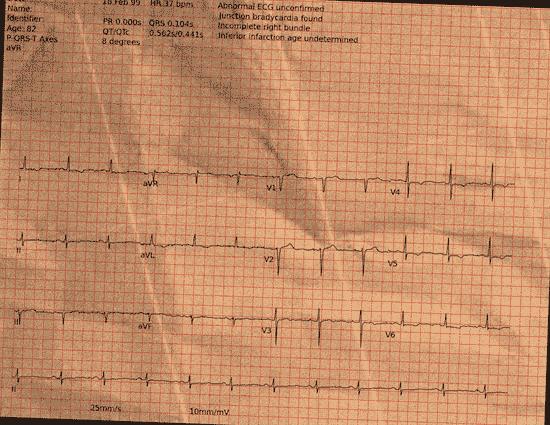 Normal ECG — PTB-XL