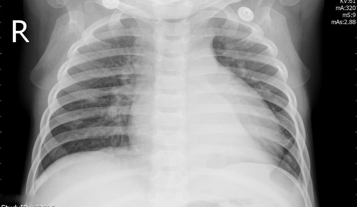 Pneumonia — NIH Chest X-ray14