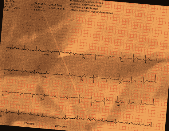Normal ECG — PTB-XL