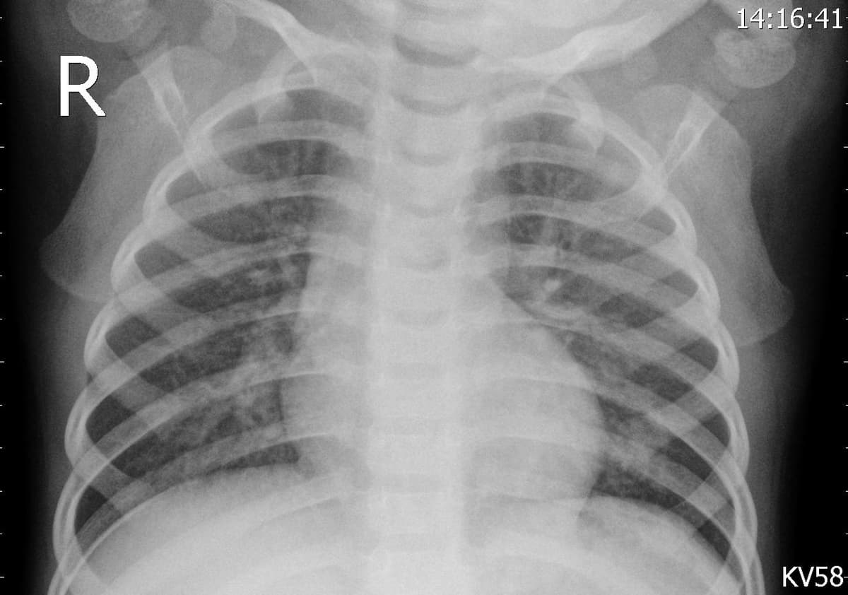 Pneumonia — NIH Chest X-ray14
