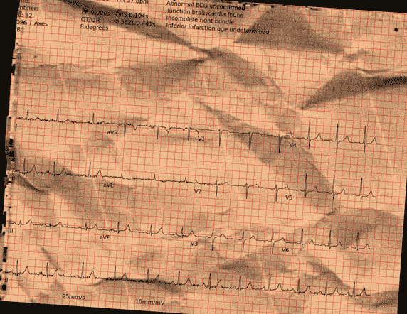 Normal ECG — PTB-XL
