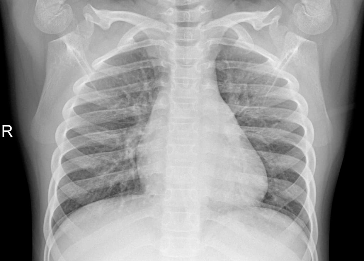 Radiografia Normal — NIH Chest X-ray14