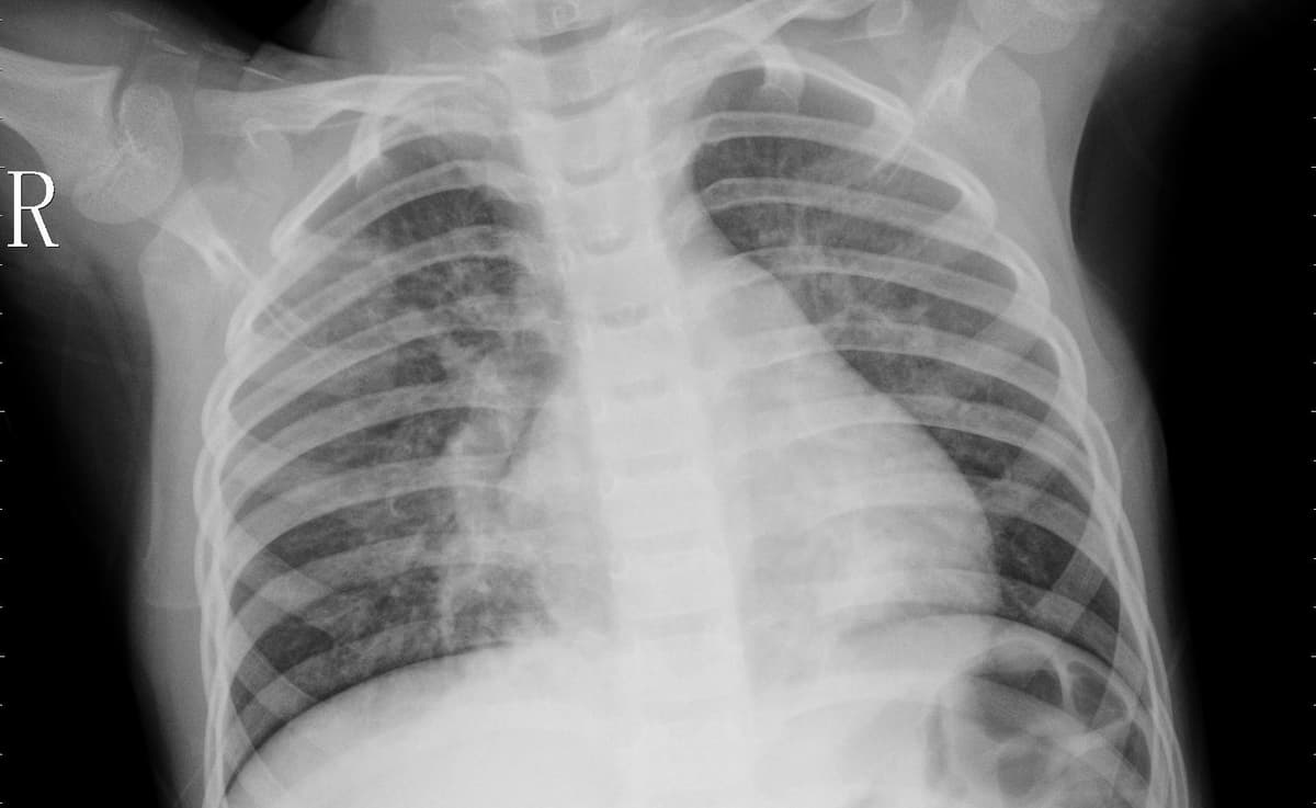 Pneumonia — NIH Chest X-ray14