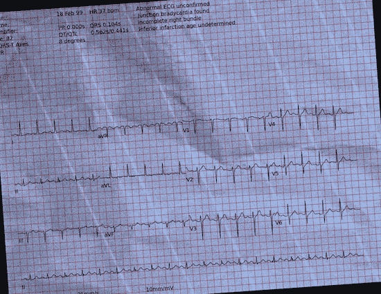Normal ECG — PTB-XL