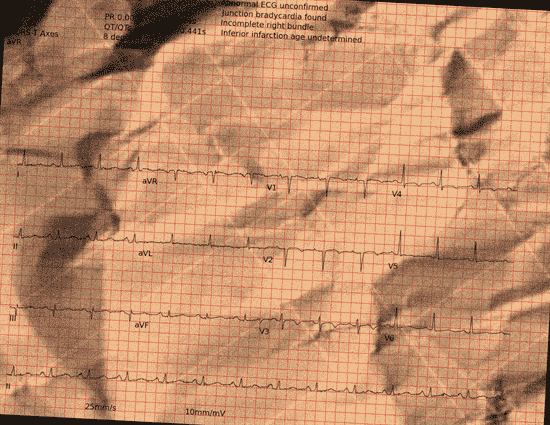 Normal ECG — PTB-XL