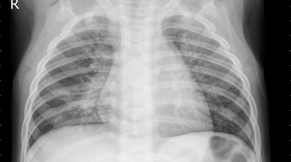 Pneumonia — NIH Chest X-ray14