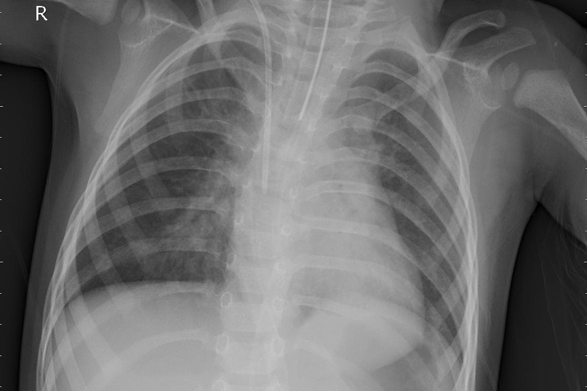 Pneumonia — NIH Chest X-ray14