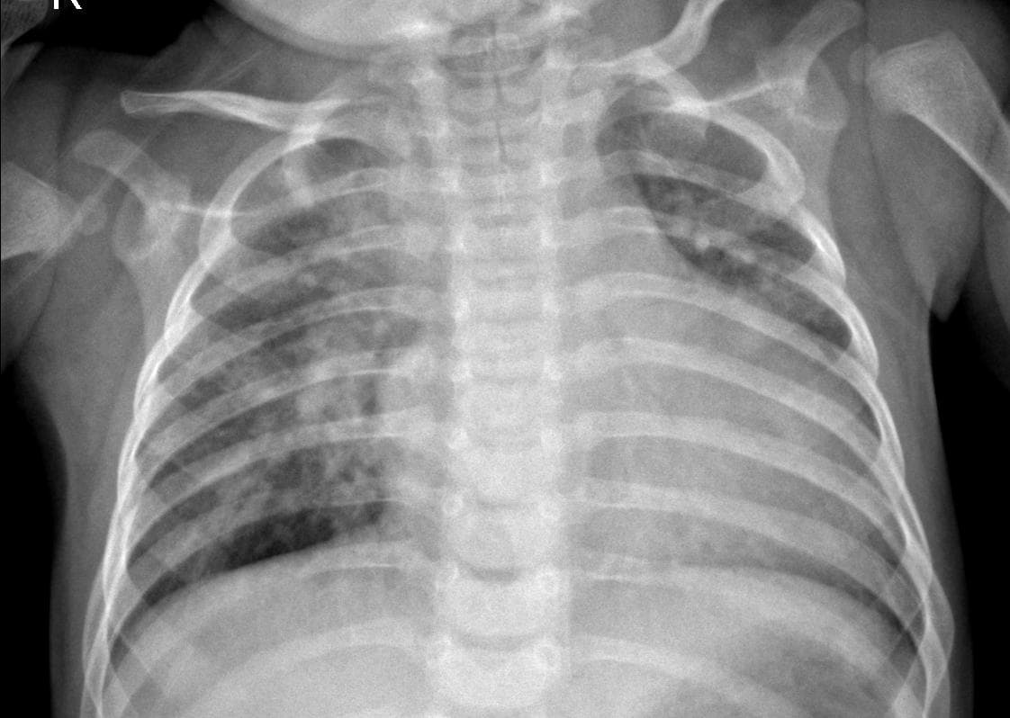 Pneumonia — NIH Chest X-ray14