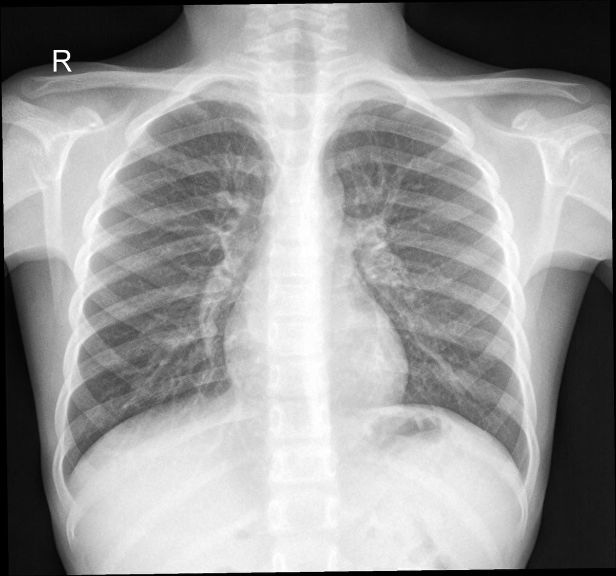 Radiografia Normal — NIH Chest X-ray14
