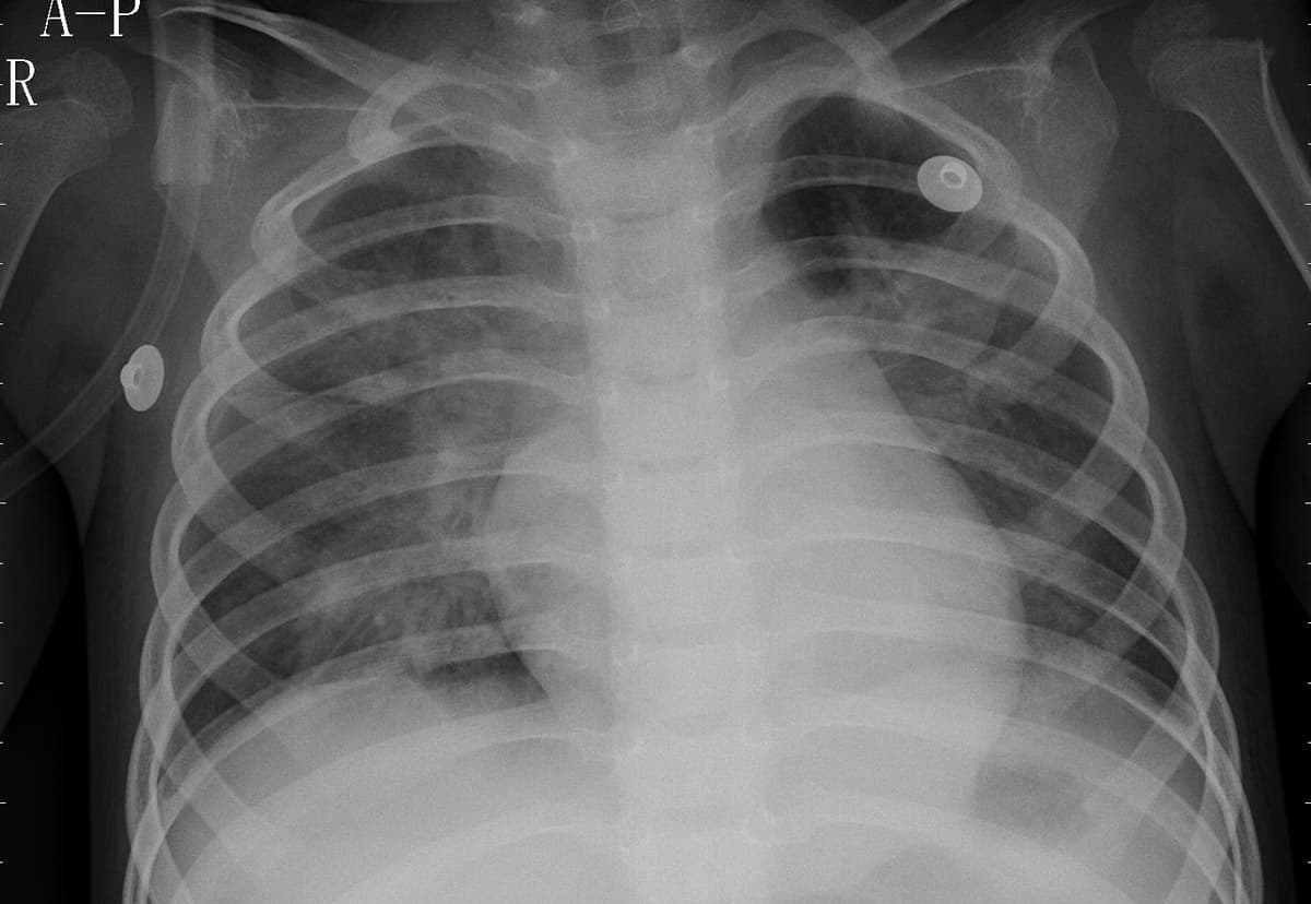 Pneumonia — NIH Chest X-ray14