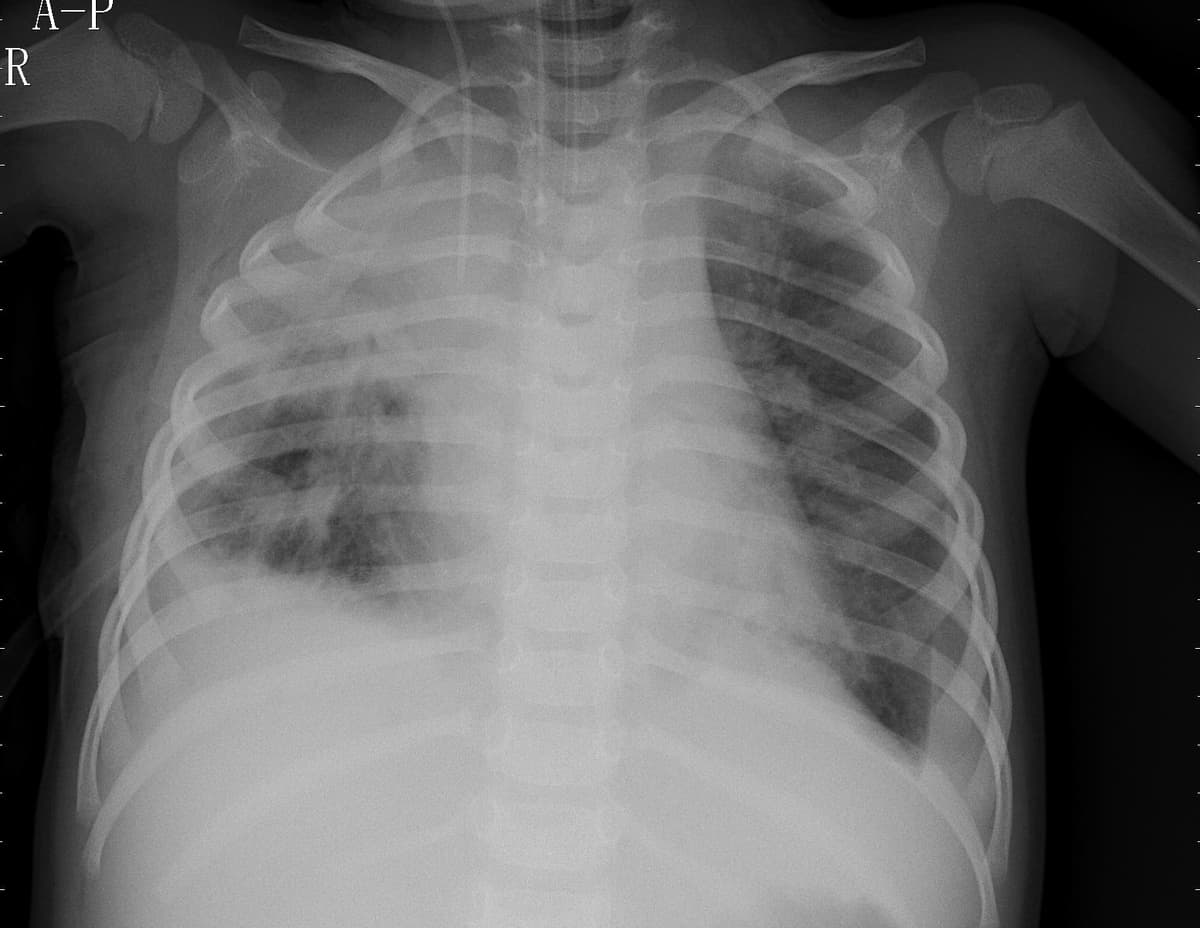 Pneumonia — NIH Chest X-ray14