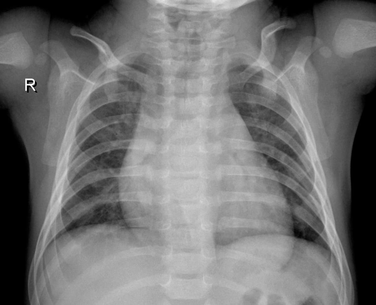 Radiografia Normal — NIH Chest X-ray14