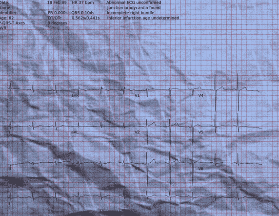 Normal ECG — PTB-XL