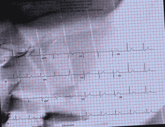 Normal ECG — PTB-XL
