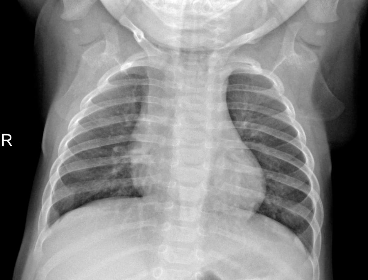 Radiografia Normal — NIH Chest X-ray14