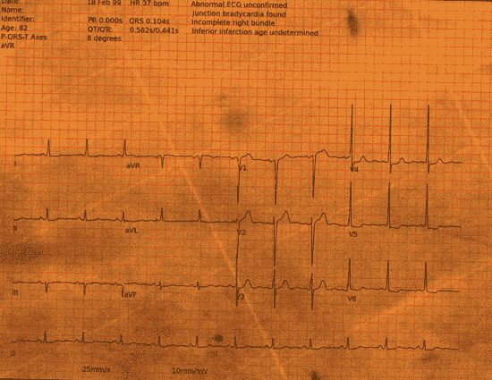 Normal ECG — PTB-XL