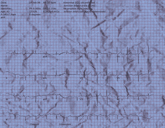 Normal ECG — PTB-XL