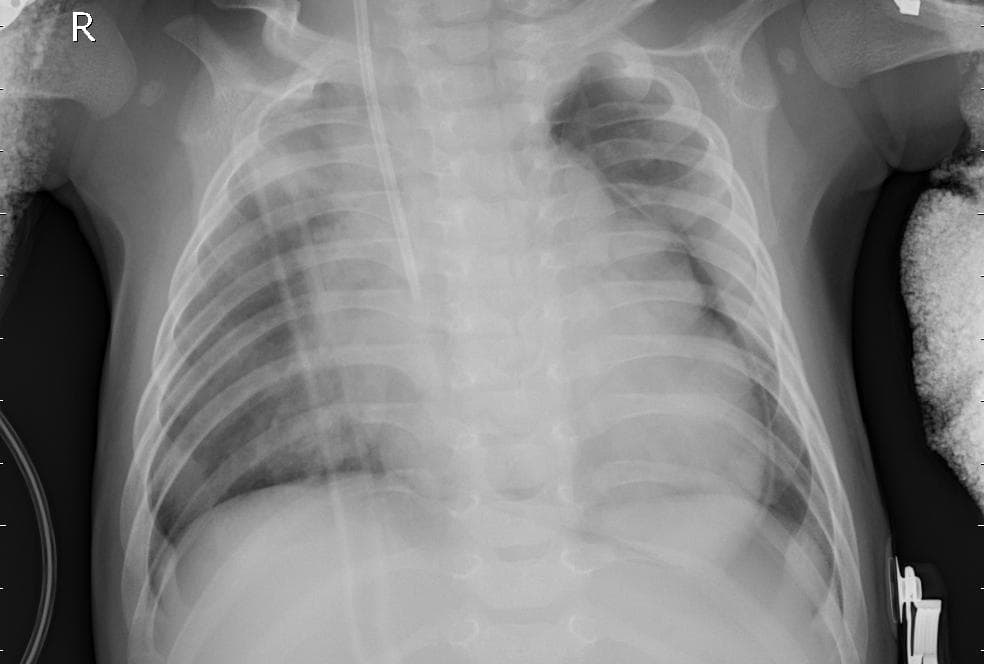 Pneumonia — NIH Chest X-ray14